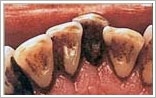 Tænder inden tandrensning